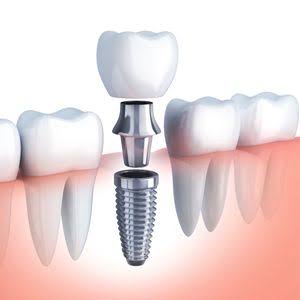글로벌 치과 보철 및 임플란트 소모품 시장